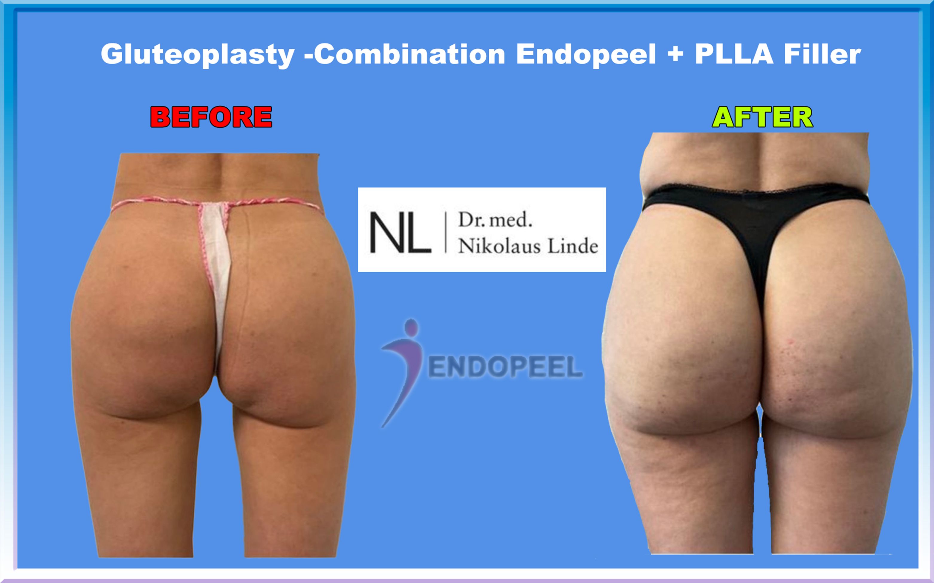 gluteo-endopeel-plla-linde.jpg