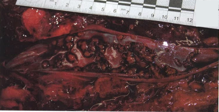 fat embolism after gluteal lipoinjection