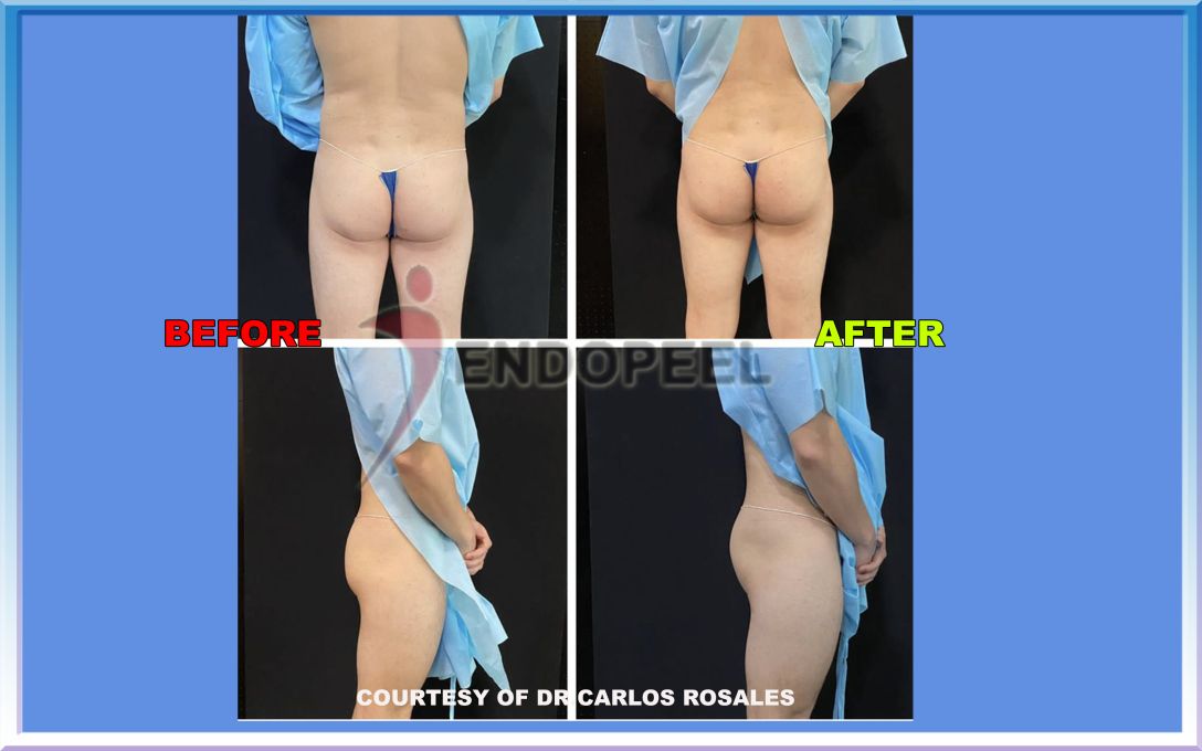 millenium-30y-male-gluteoplasty