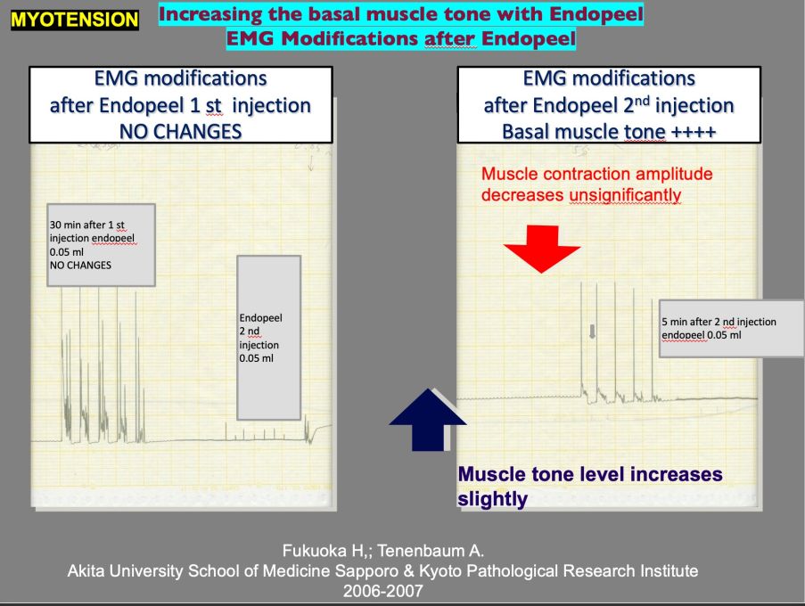 myotension