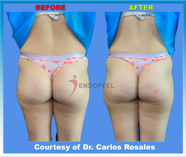 economic female gluteoplasty posterior view