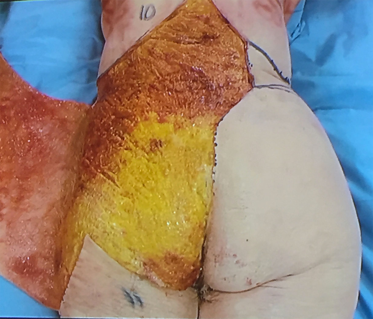 Cadaveric dissection showing gluteal subcutaneous fat and adjacent intact skin