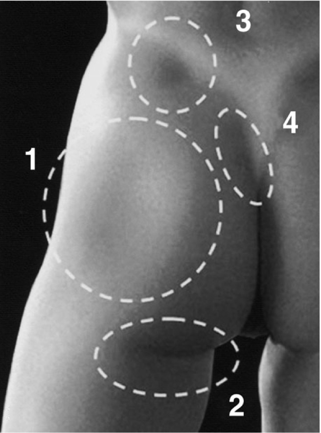 Photograph indicating lateral depression, infragluteal fold, supragluteal dimple and upper intergluteal crease