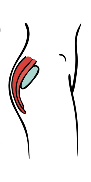 deep-undermuscular-implant