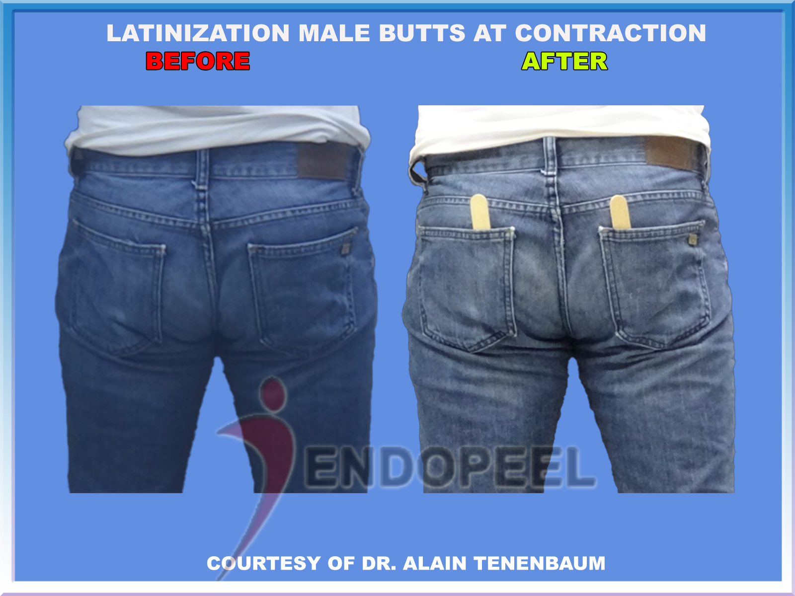 Male buttock Latinization before and after during muscular contraction