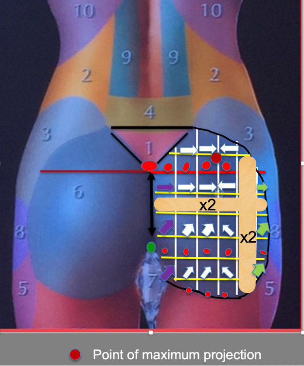 Three-dimensional contour mapping for male buttock feminization