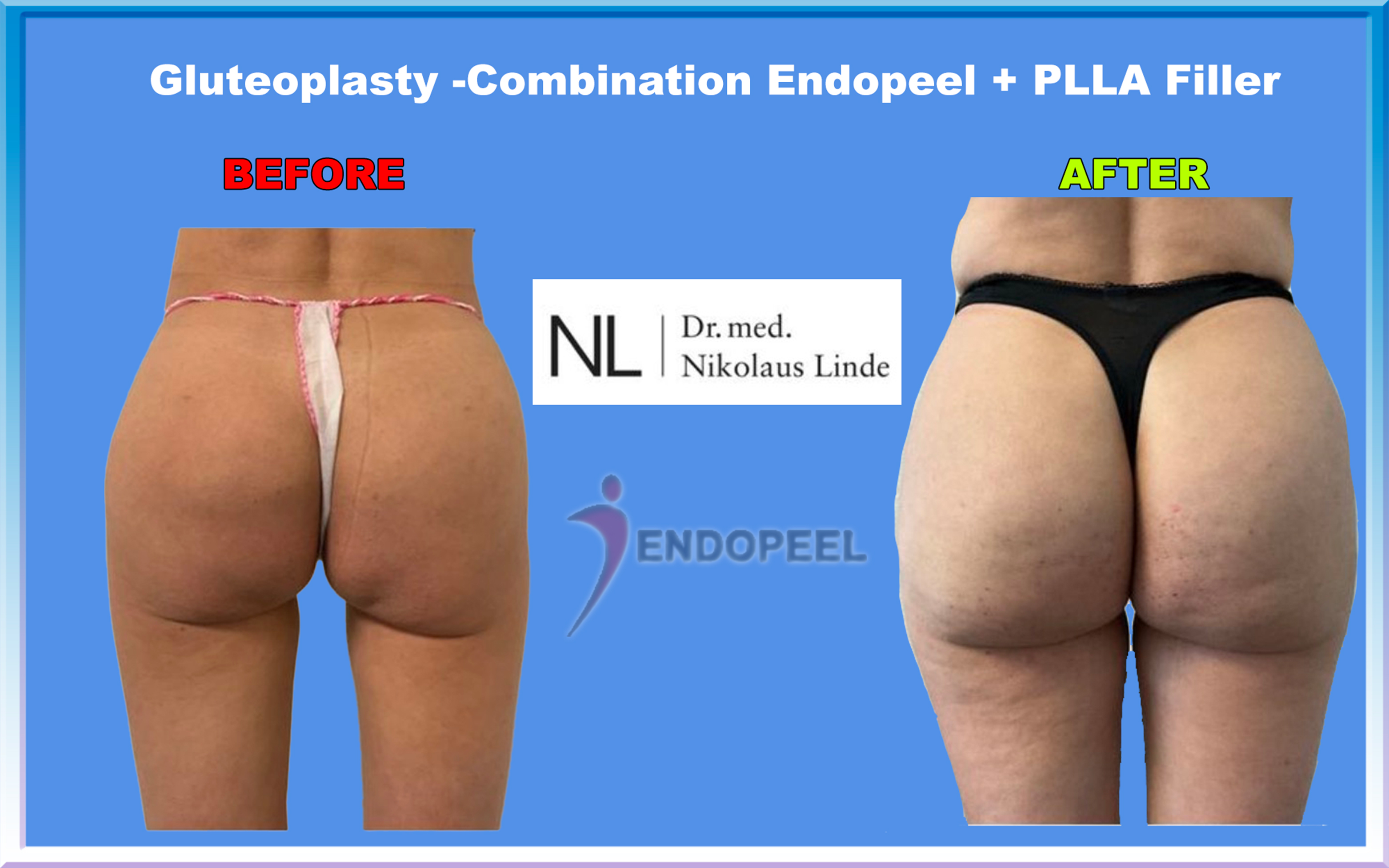 luteo-endopeel-plla-linde.jpg
