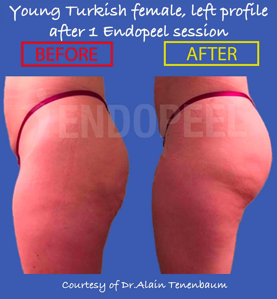 Gluteoplasty-Young Turkish female, left profile, after 1 Endopeel session