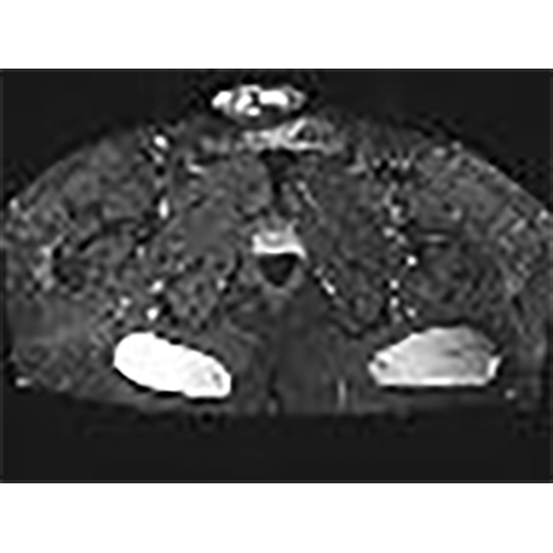 depth-gluteal-implant-1.