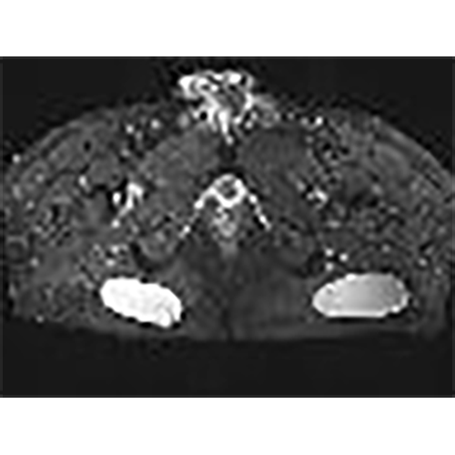 depth-gluteal-implant-2