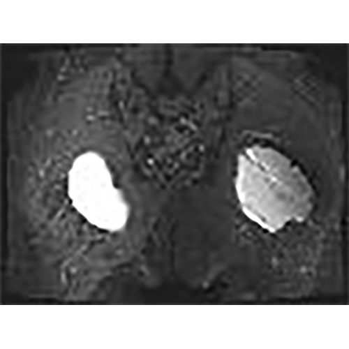 position-gluteal-implant-1