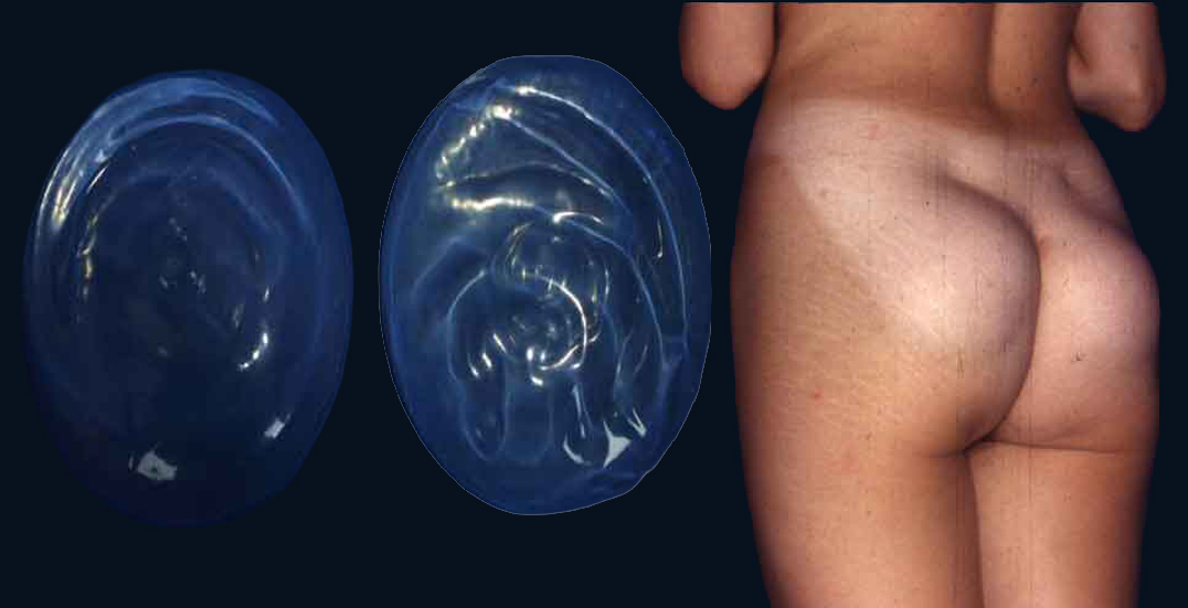 Gluteal implants beside a female clinical example illustrating implant-created projection