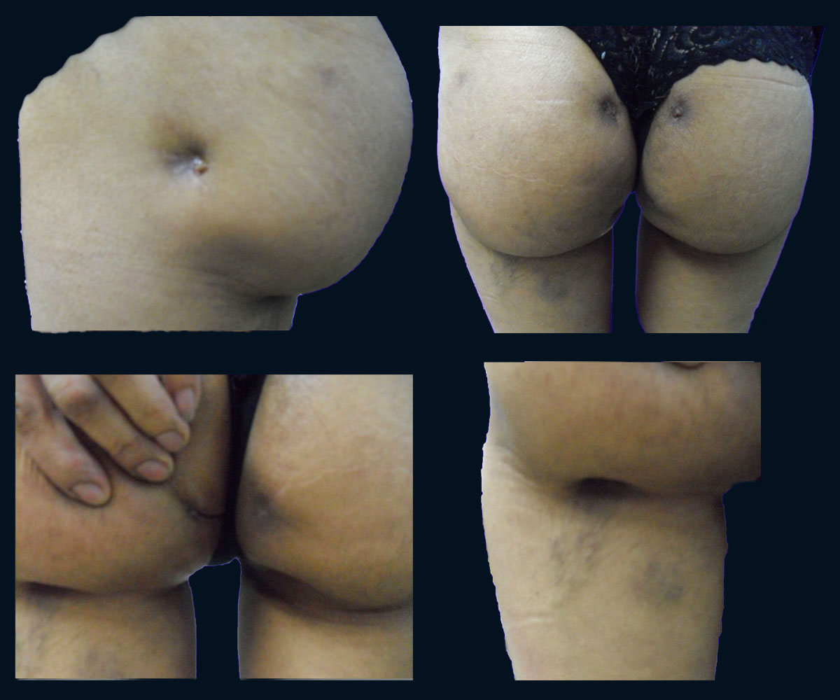 Four clinical views of localized gluteal contour depressions and tissue distortion in a female patient