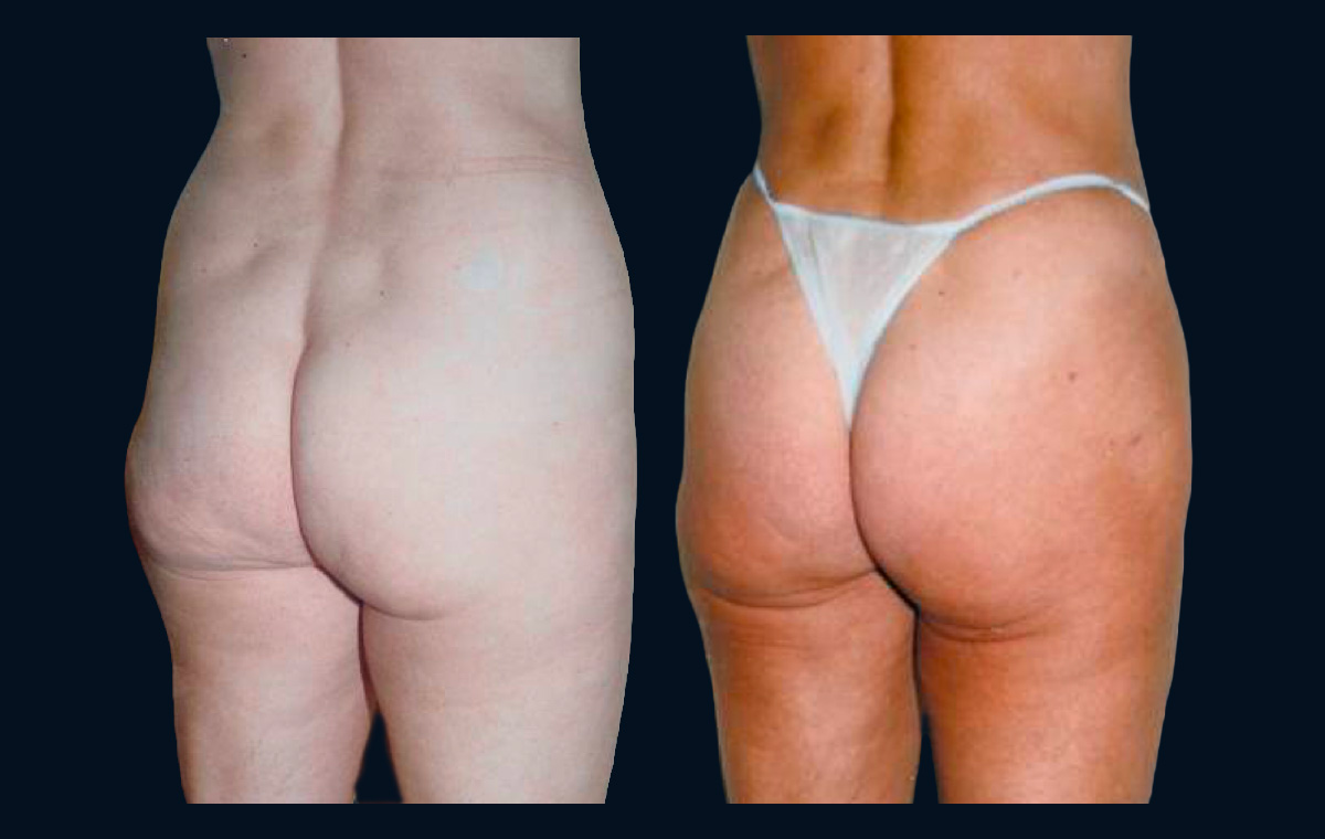 Female clinical comparison illustrating increased gluteal volume without equivalent improvement in structural support