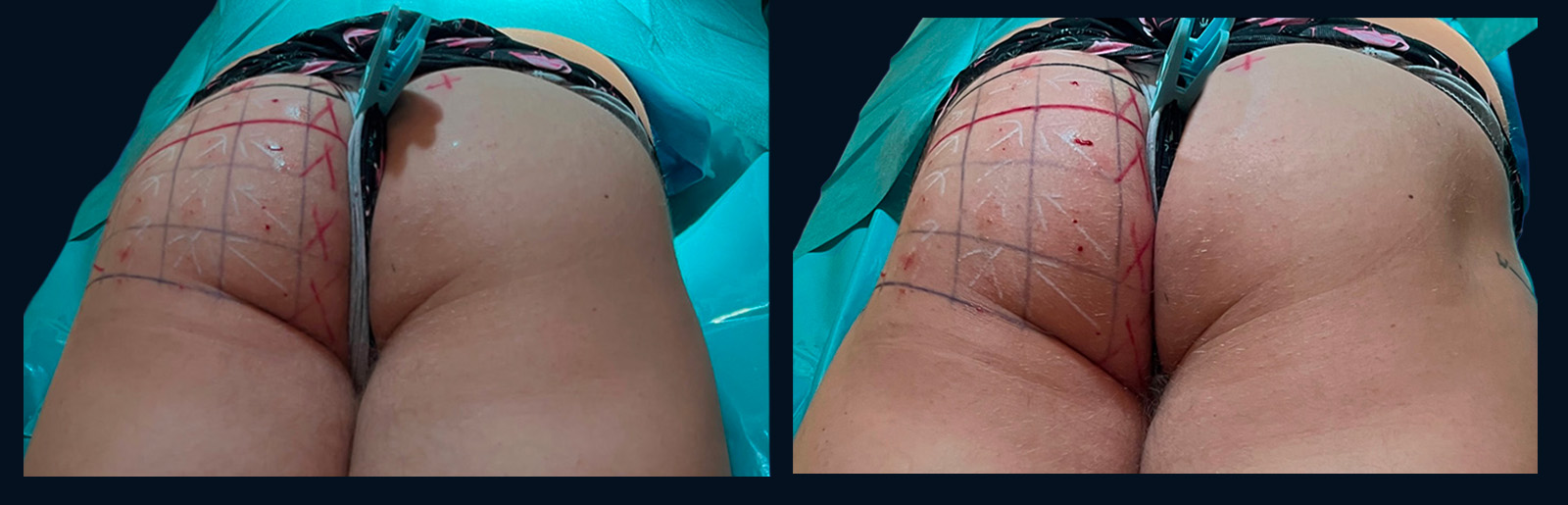 Male gluteal myomodulation at relaxation and contraction 30 minutes after treatment, with only the patient's left side treated