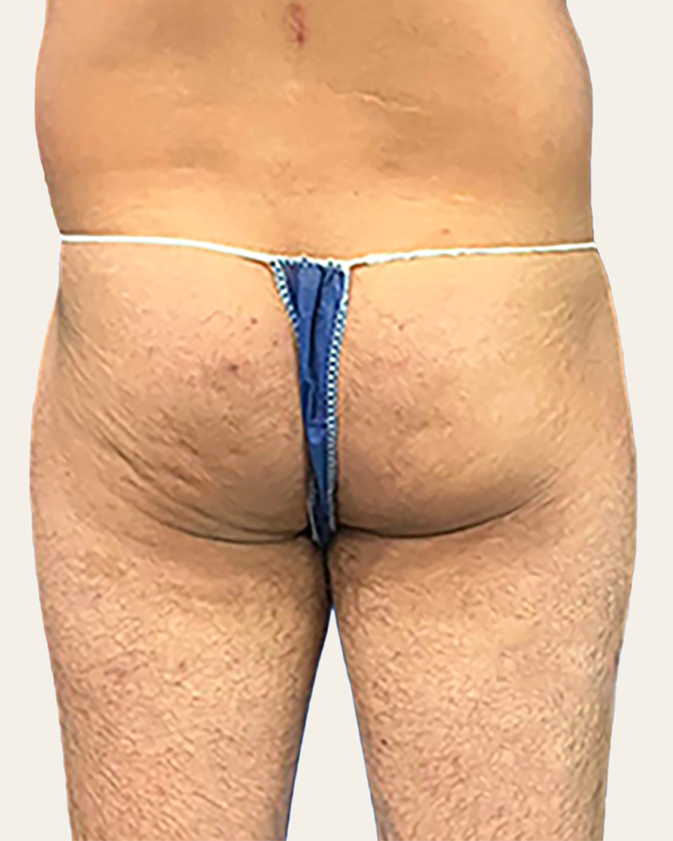 Posterior view illustrating loss of gluteal support in a male patient