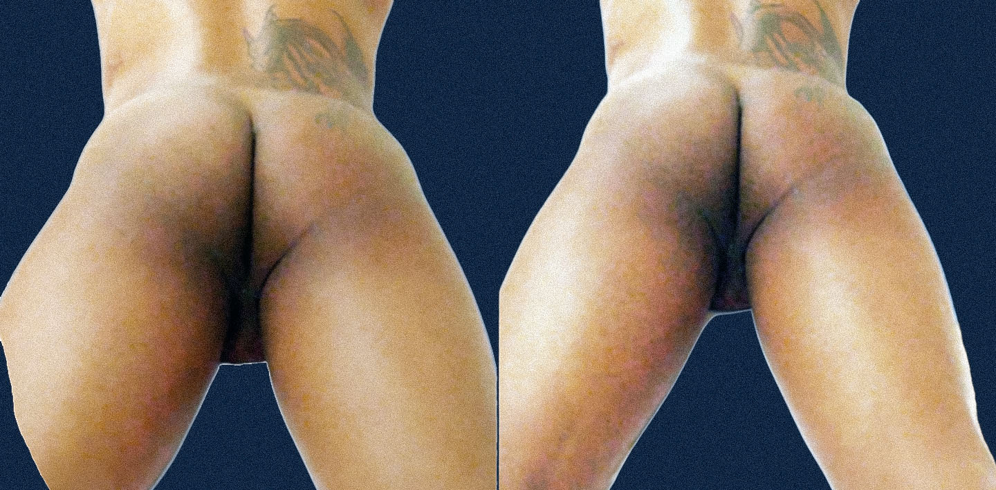 Male gluteal contour at relaxation 30 minutes after unilateral myomodulation, shown from two complementary viewing angles, with the patient's left side treated and right side untreated