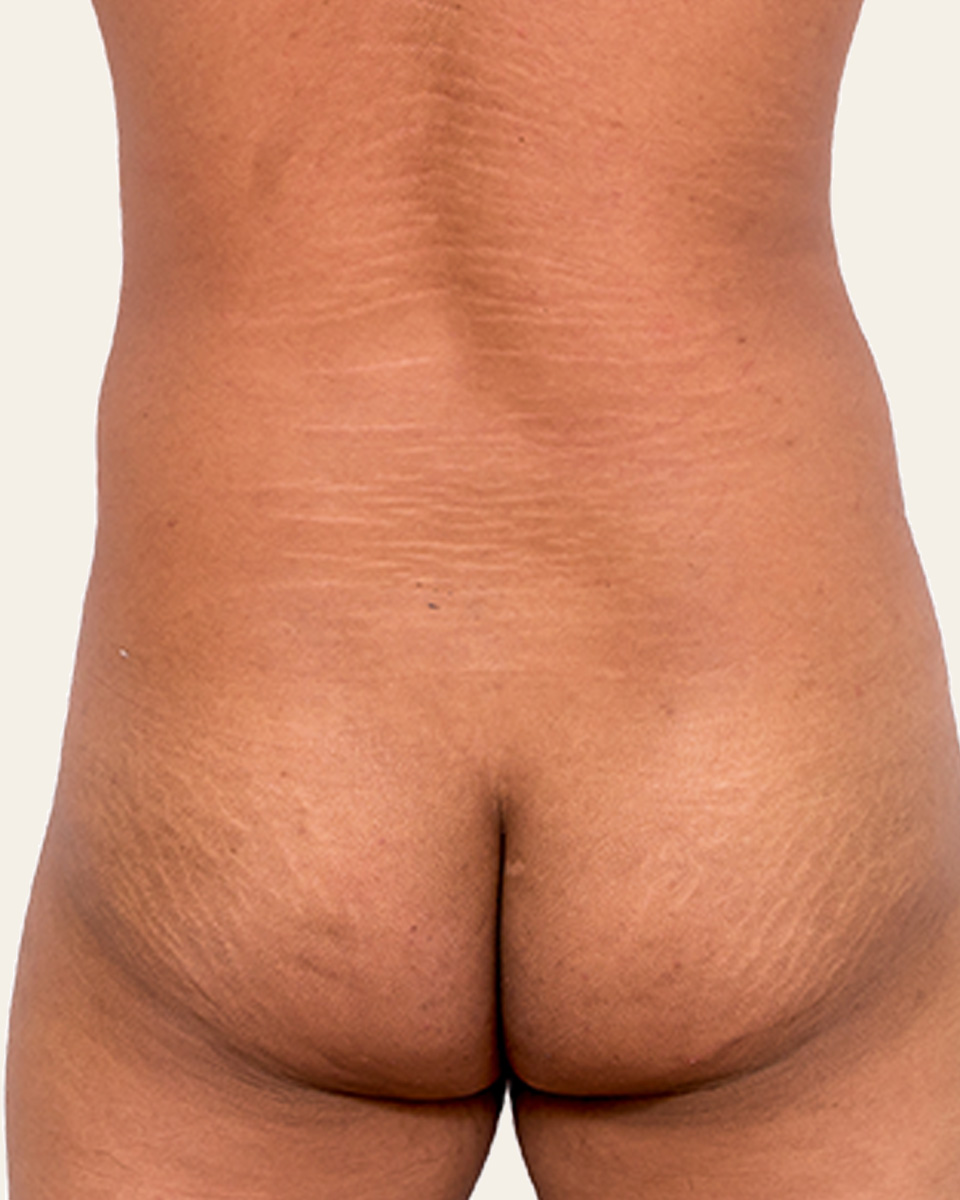 Posterior view illustrating the relationship between torso width and gluteal contour