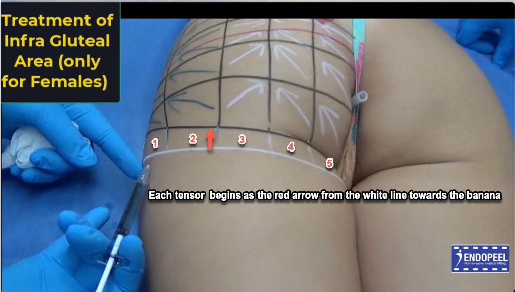 nfra-gluteal-area-inj0