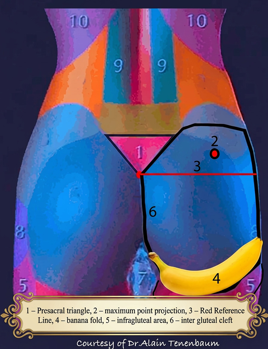 Gluteal anatomical landmarks showing the presacral triangle, maximal projection point and red reference line