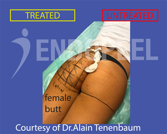latin-profile-result--Left-butt