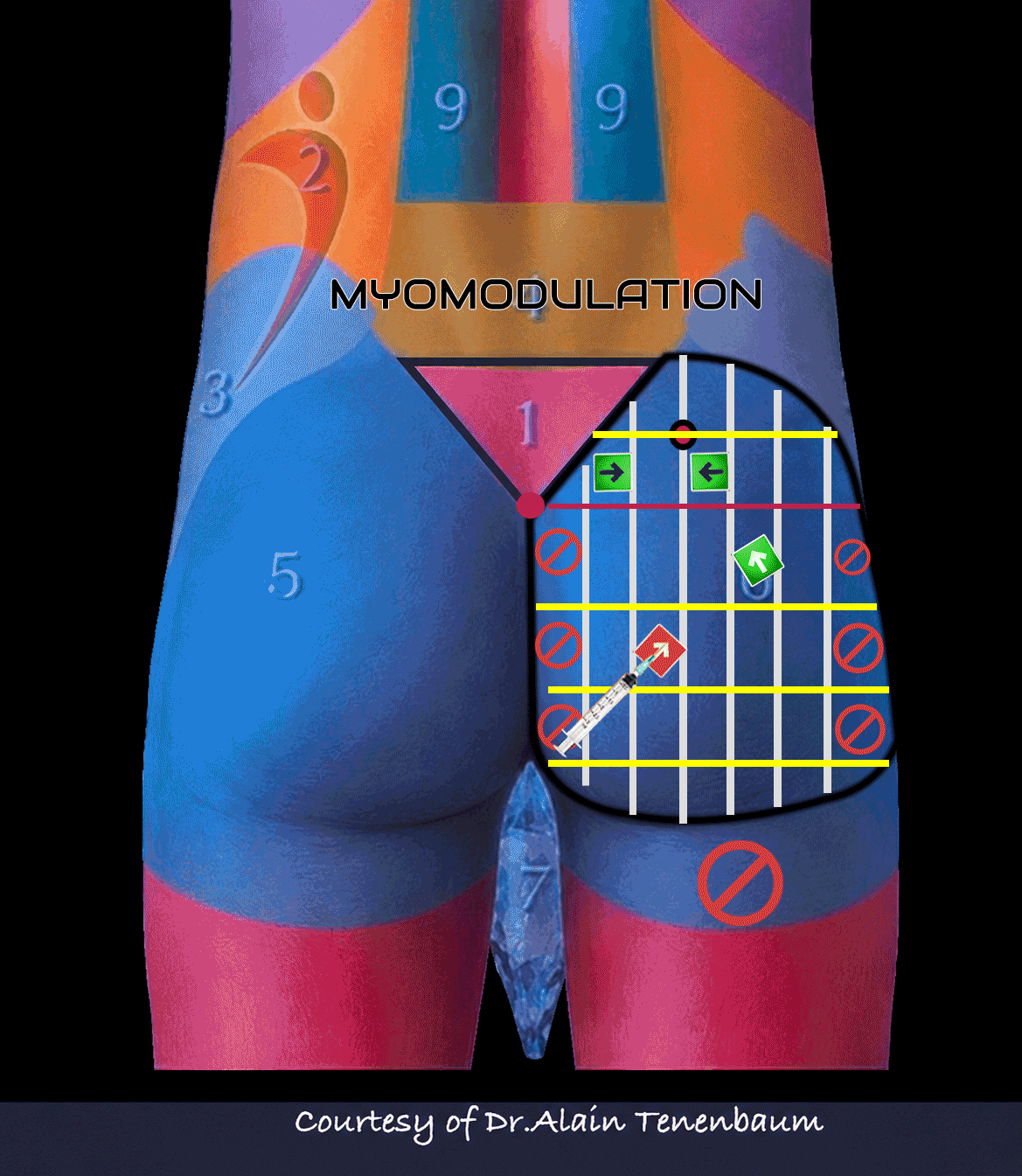Animated clinical application of tensor injections in male gluteal Myomodulation