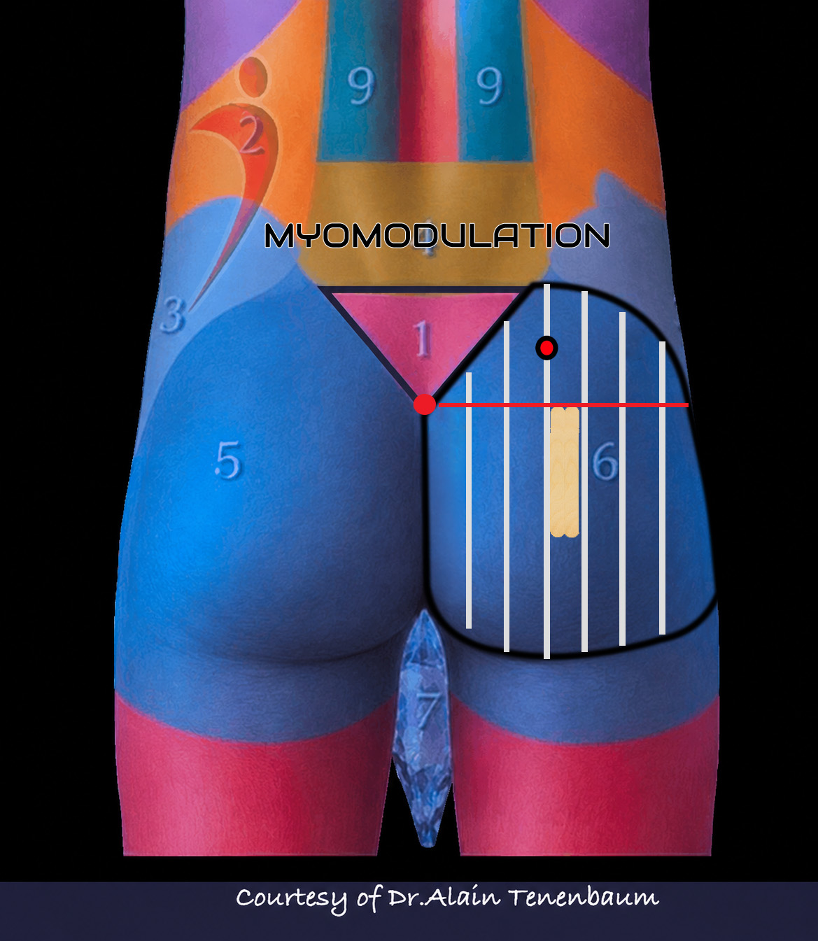 Longitudinal treatment columns used in male gluteal mapping