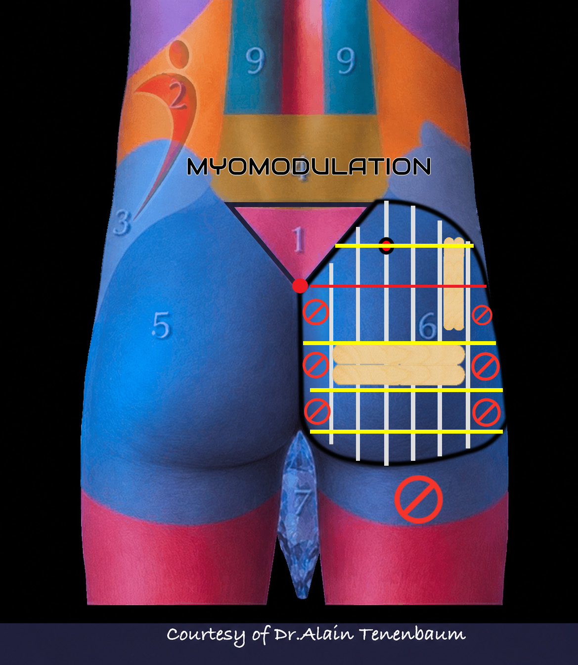 Transverse treatment levels completing male gluteal volumetric mapping