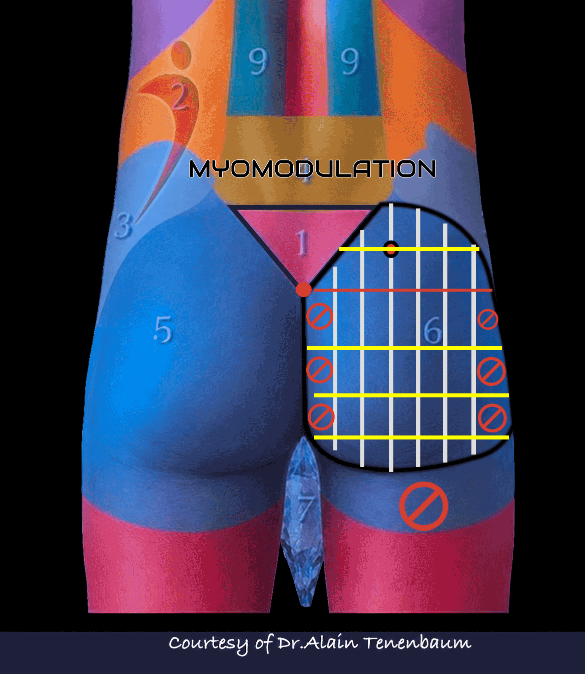 Animated male gluteal vector design showing standard male treatment mapping and feminization-specific territories