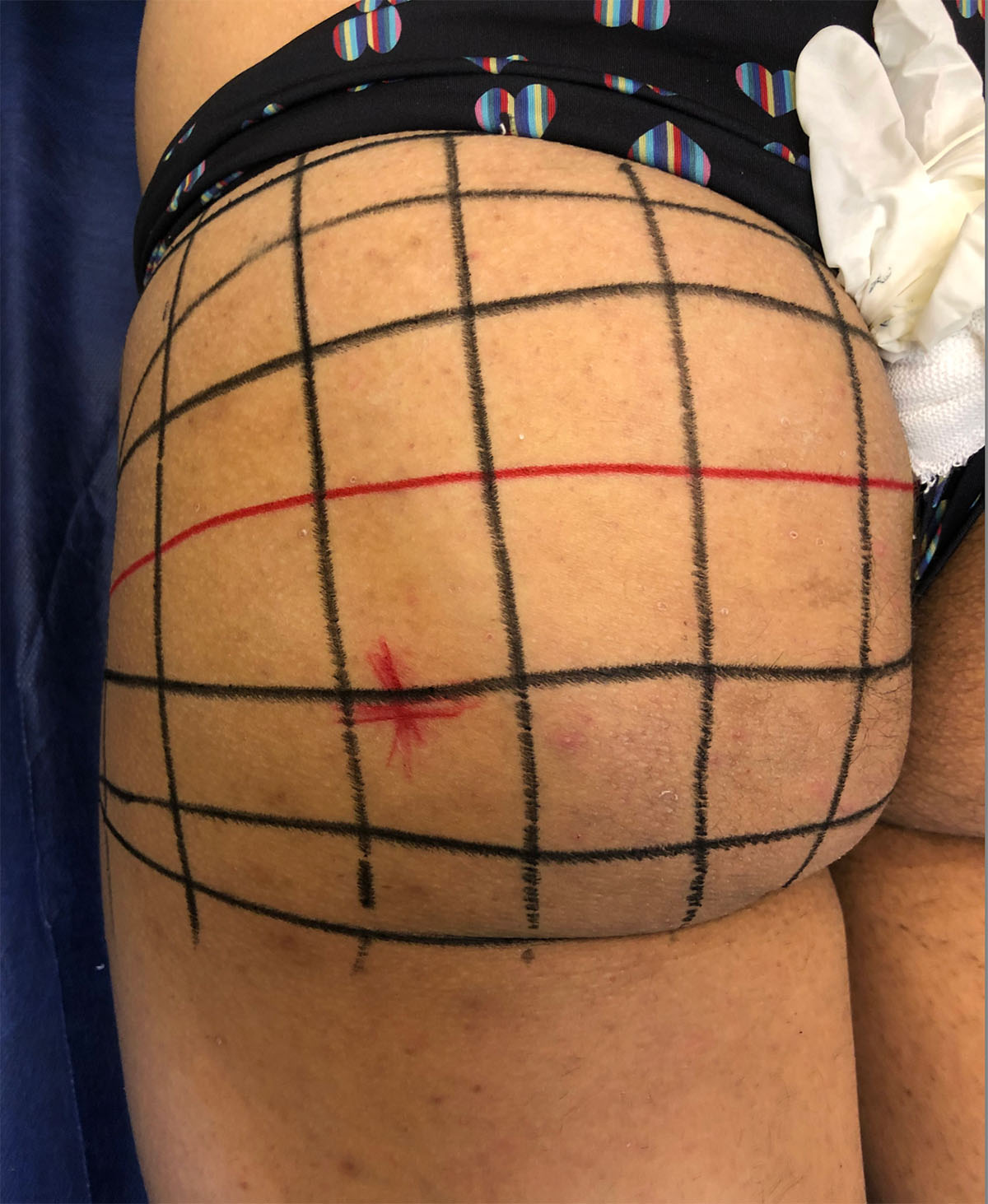 Male gluteal volume divided into a clinical grid representing three-dimensional volumetric units