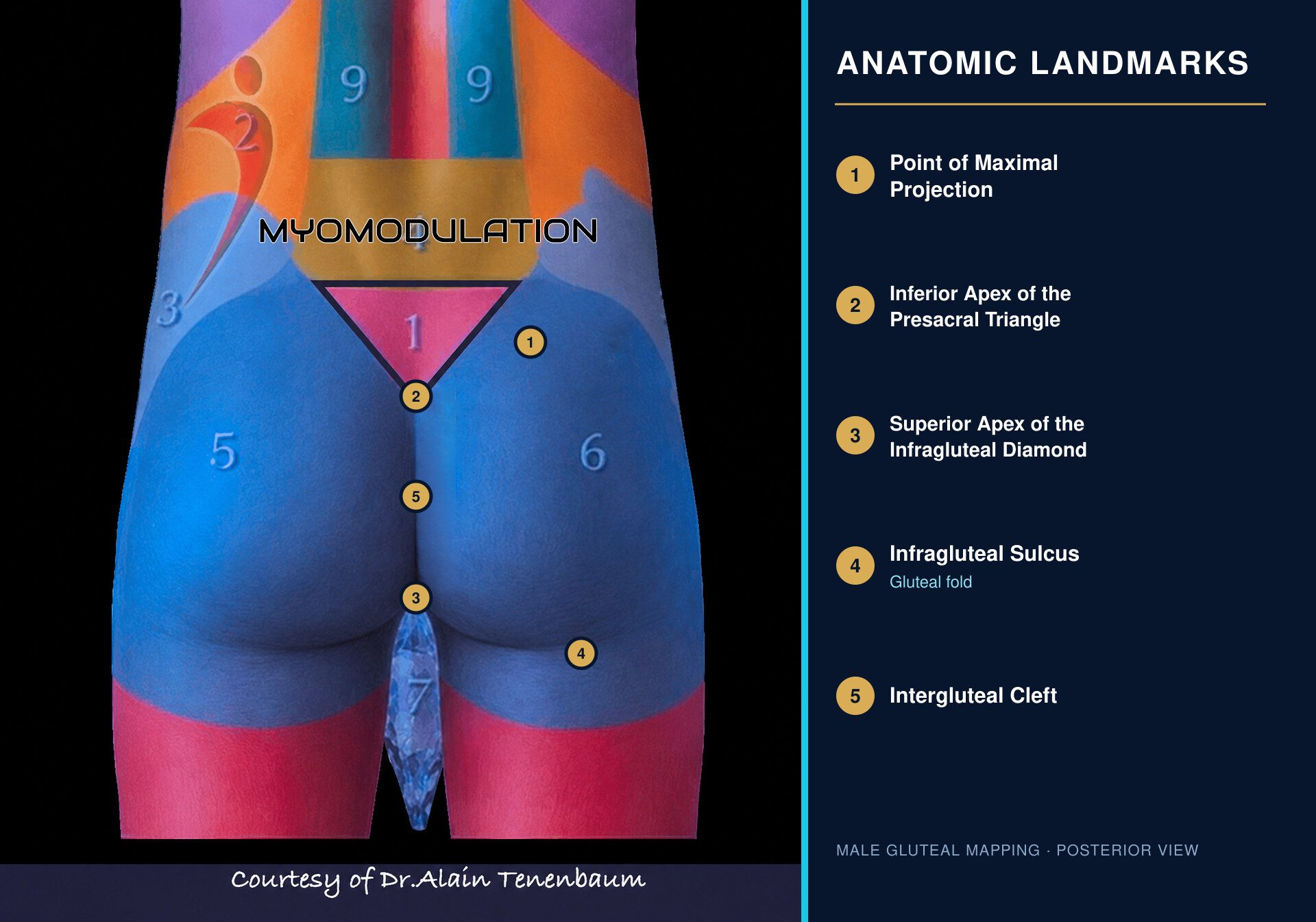 Male gluteoplasty anatomical landmarks for three-dimensional Myomodulation planning