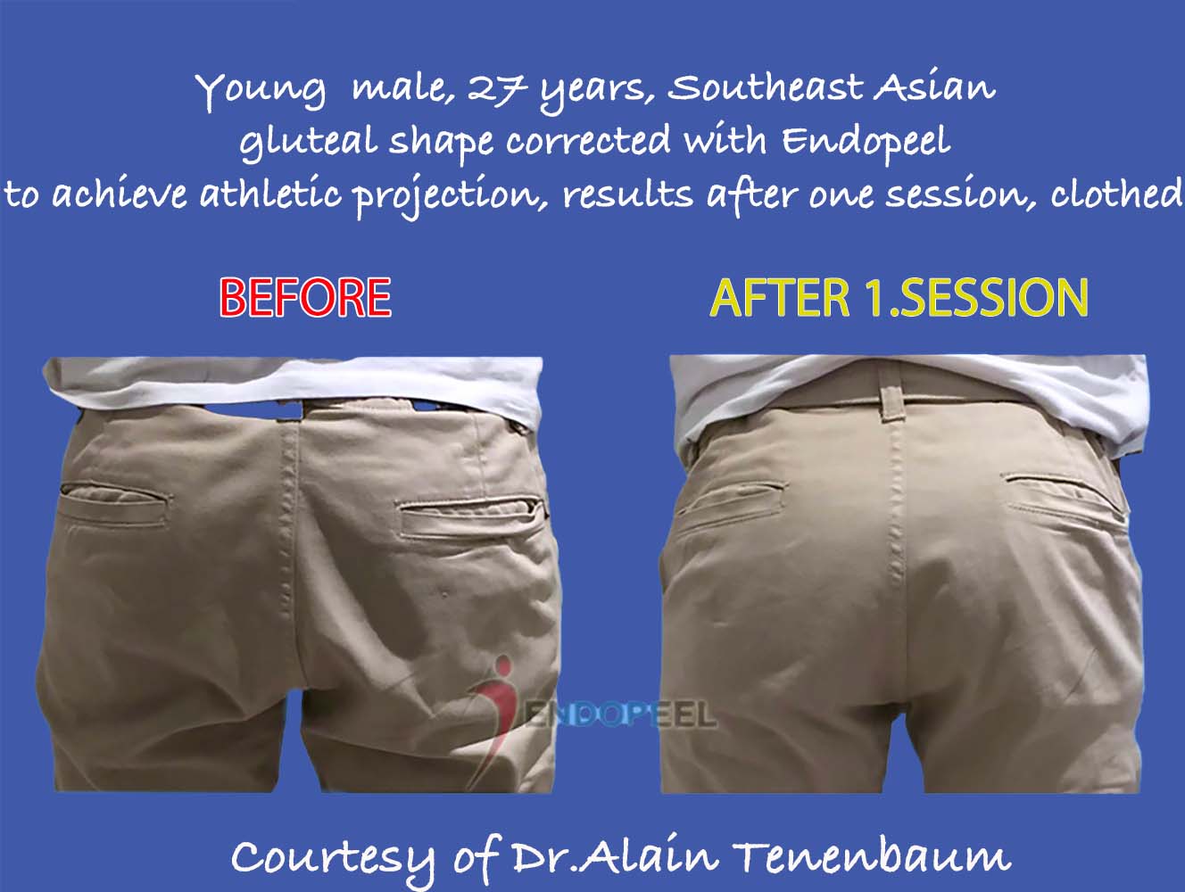 Gluteal projection in profile · Source: Gluteoplasty.com.