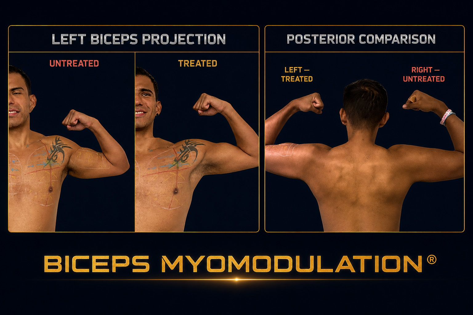 Biceps myomodulation clinical comparison showing the untreated and treated left biceps and a posterior comparison with the untreated right arm