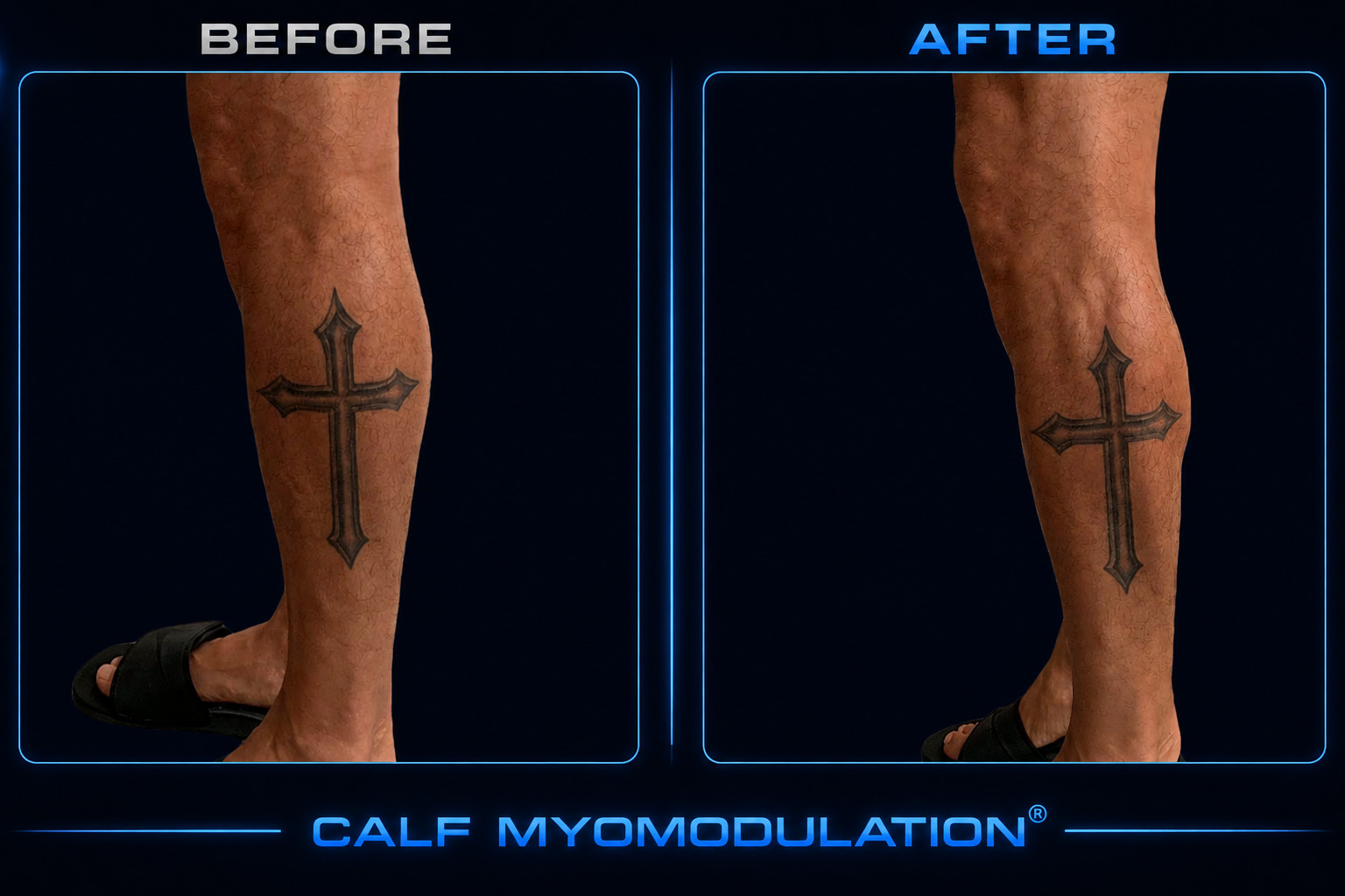 Calf myomodulation clinical result shown before and after treatment in a male patient