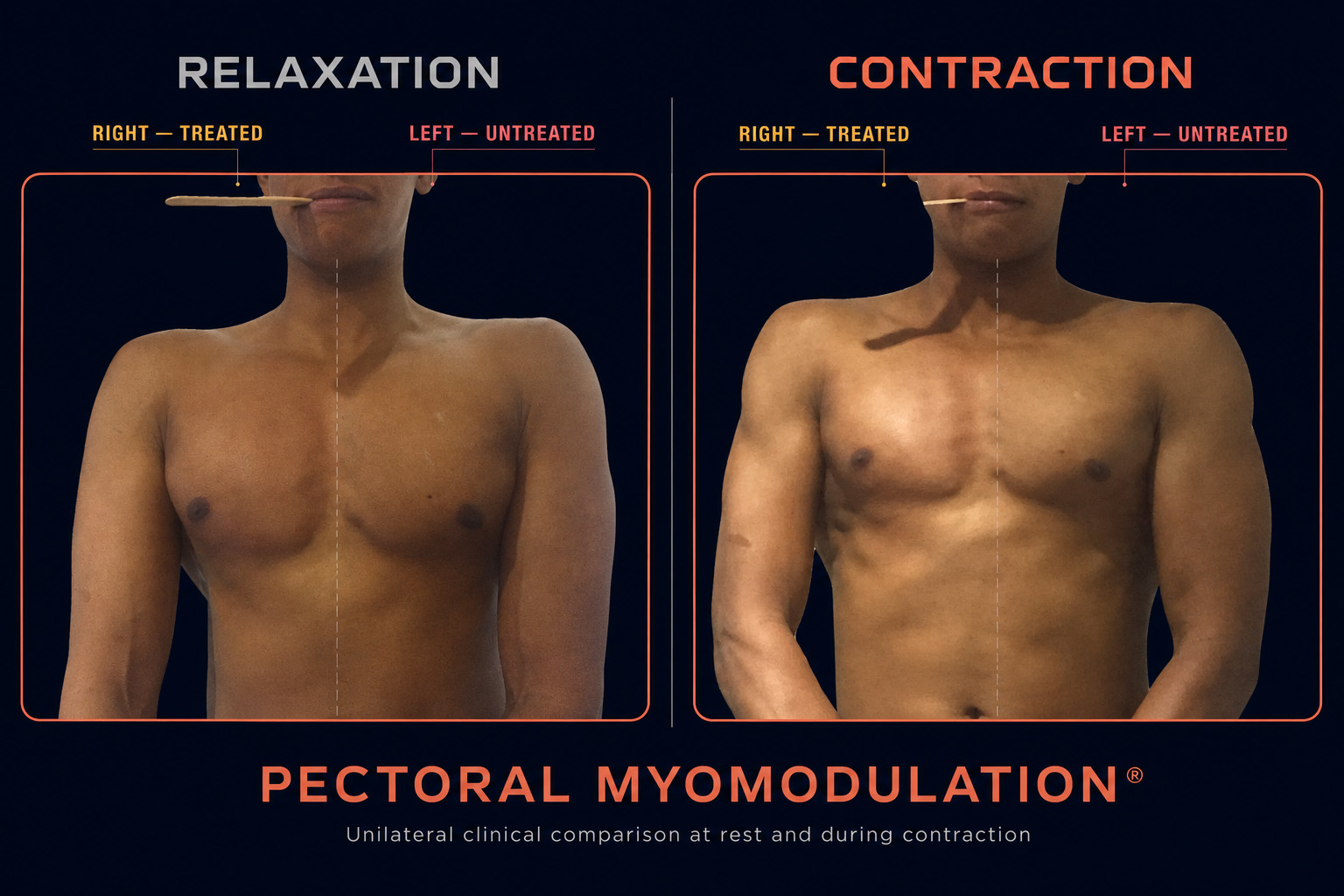 Unilateral pectoral myomodulation comparison showing the treated right pectoral and untreated left pectoral at rest and during muscular contraction