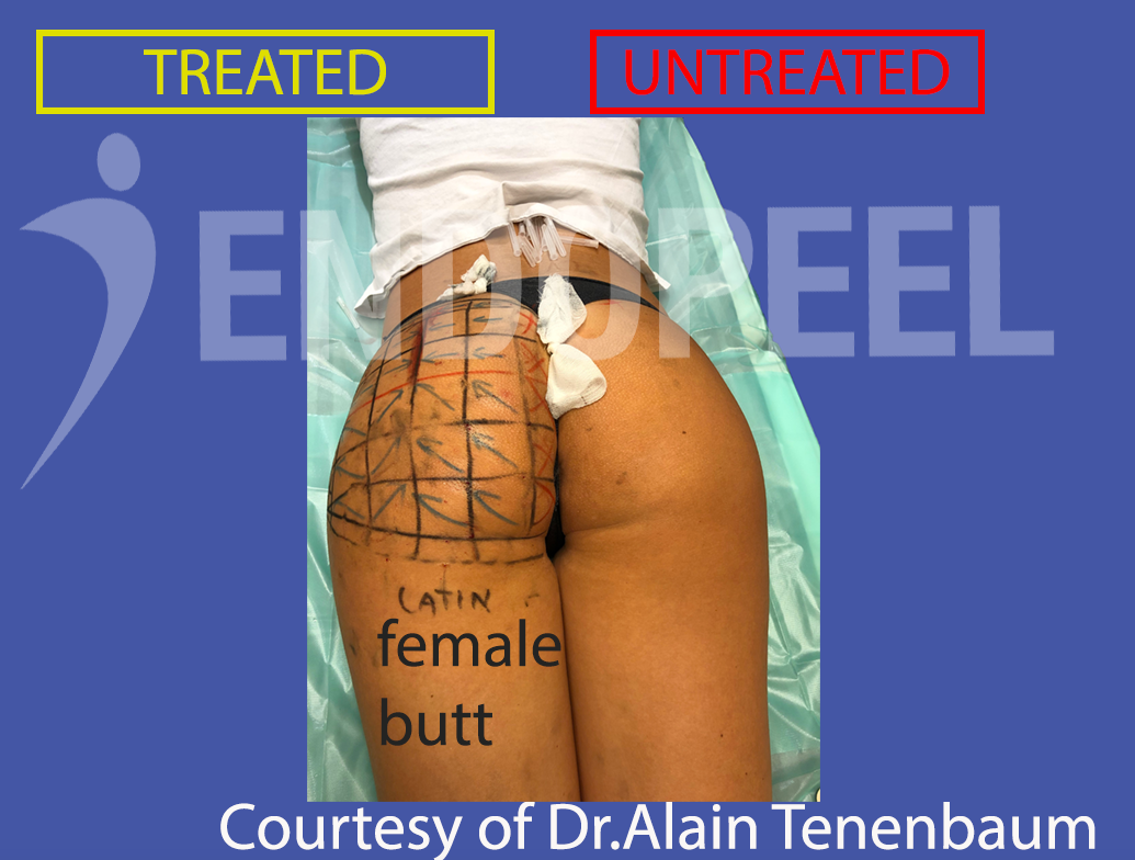 immediate result of latino female butt