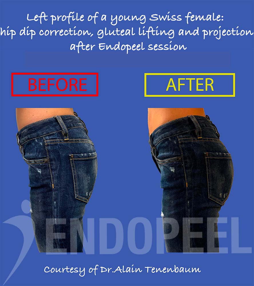 Left profile of a young Swiss female: hip dip correction, gluteal lifting and projection after Endopeel session, visible even in clothing