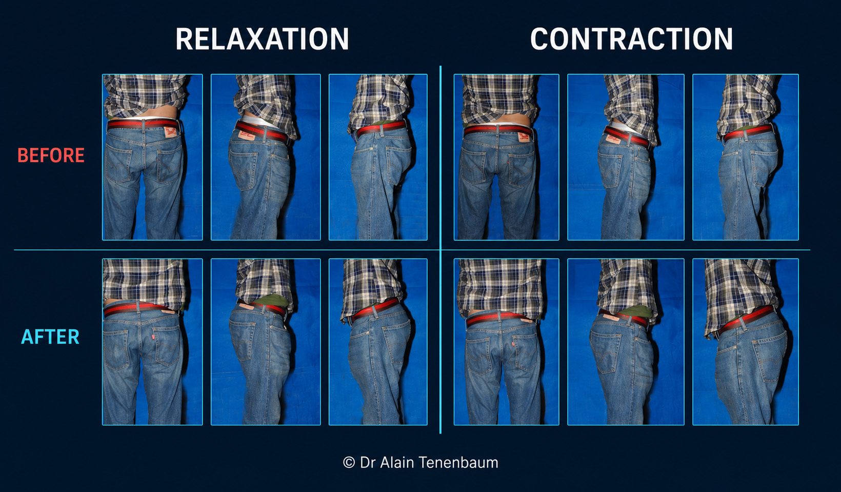Male gluteoplasty results compared before and after treatment in posterior, oblique and lateral views, at rest and during muscular contraction