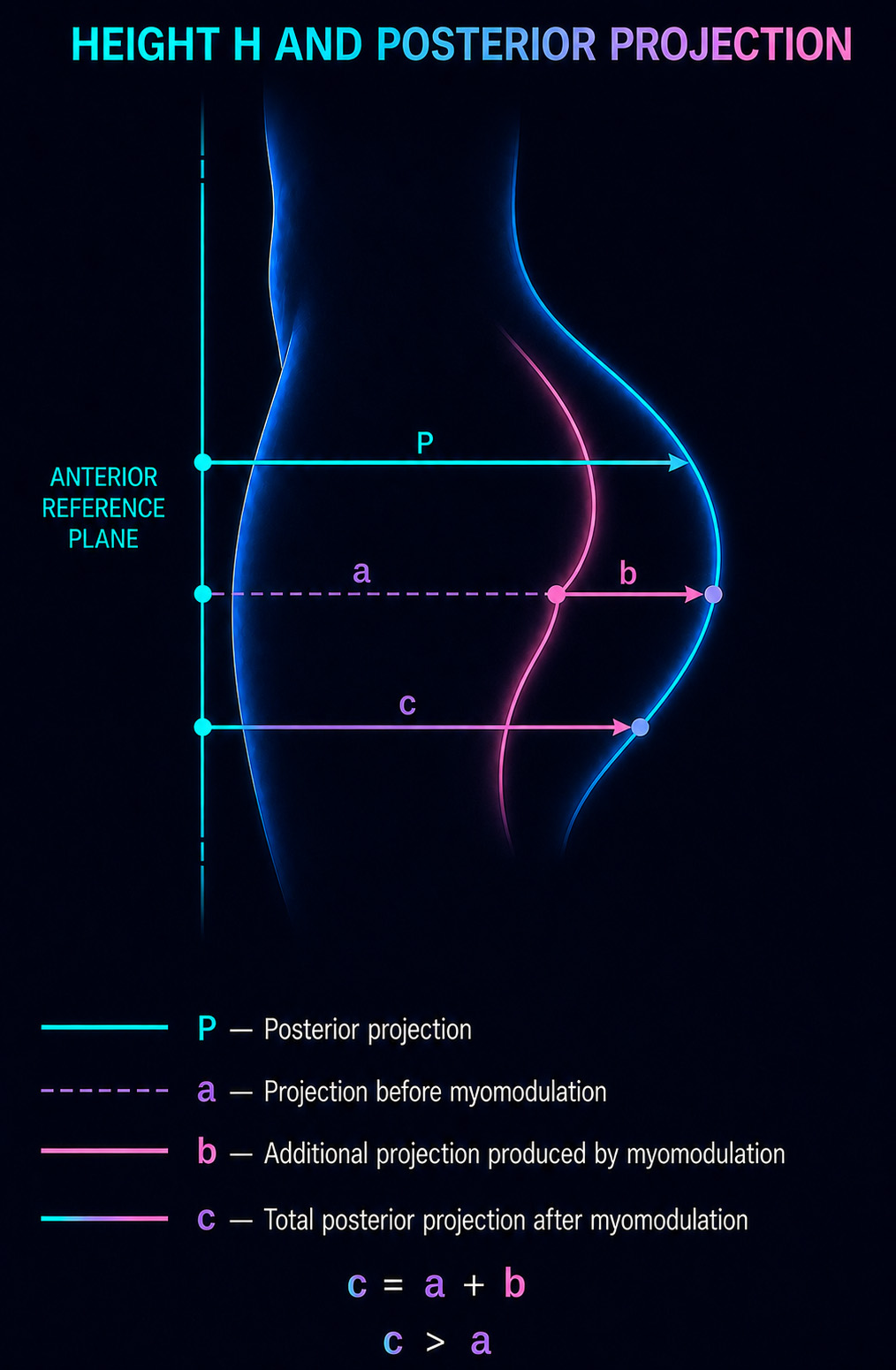 BBL with volume-based gluteal projection