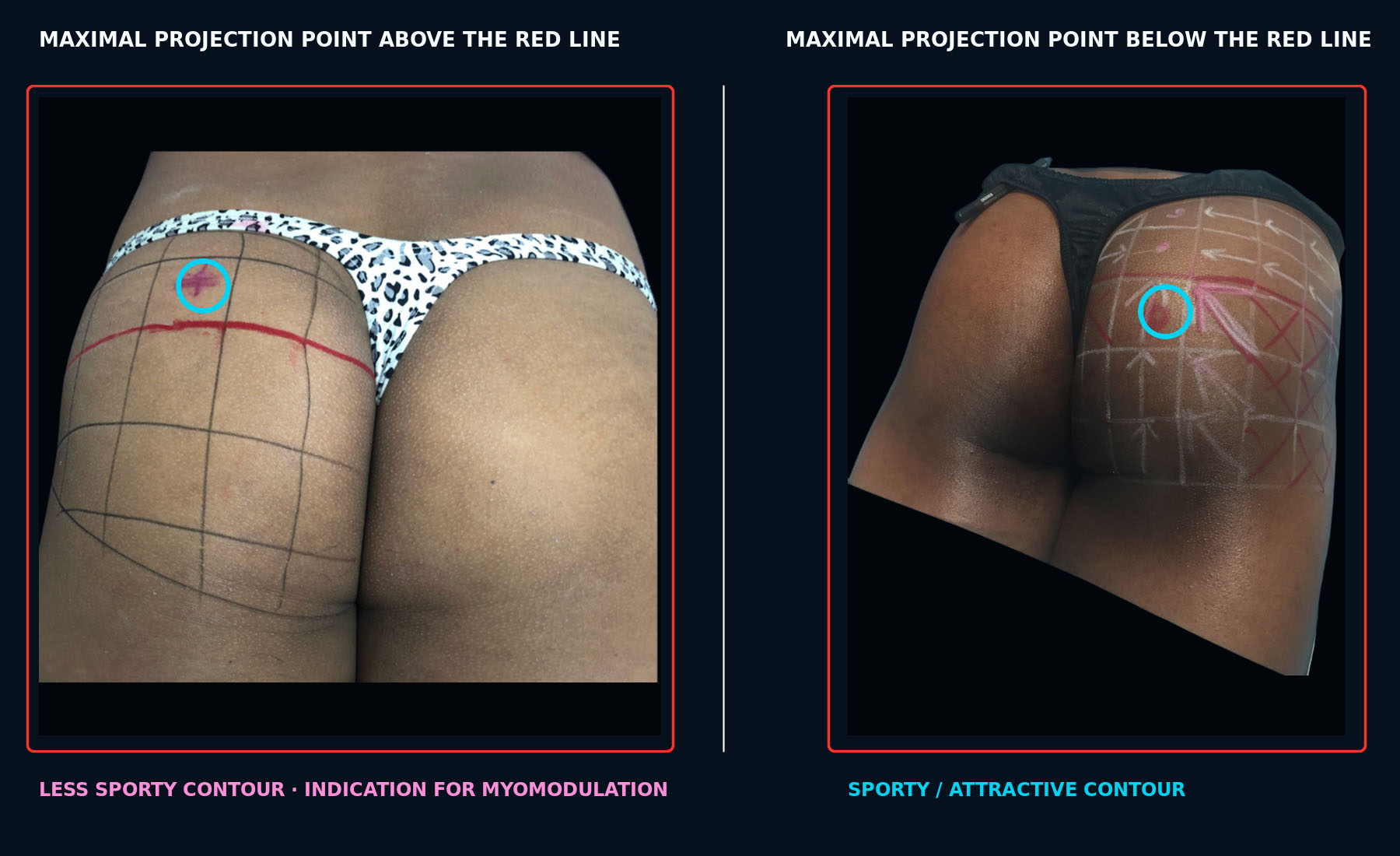Comparison of the maximal gluteal projection point above and below the red reference line