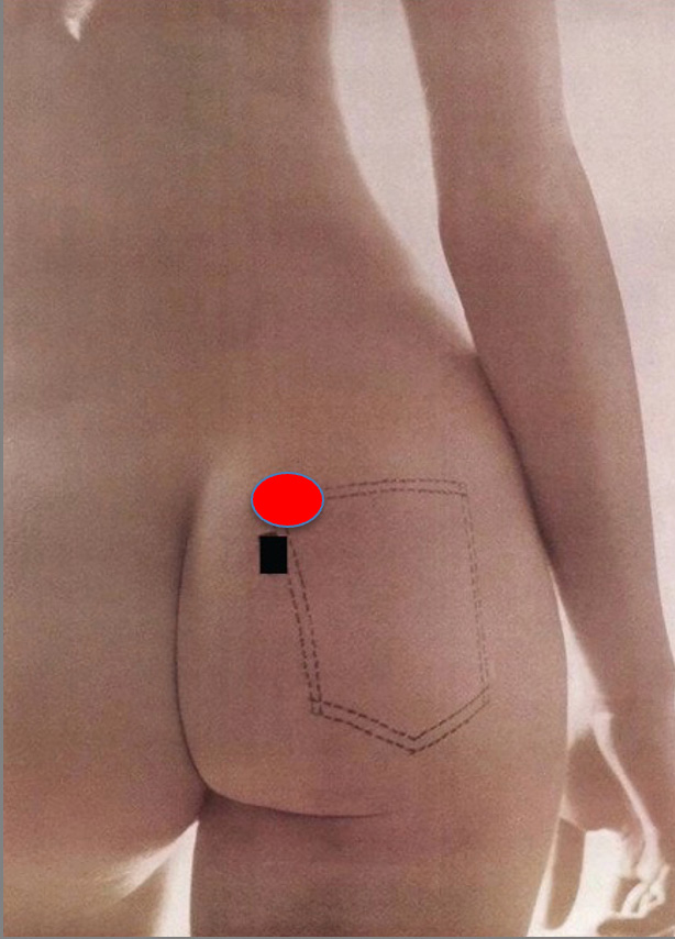 Observed point of maximal gluteal projection transferred to the nude gluteal contour