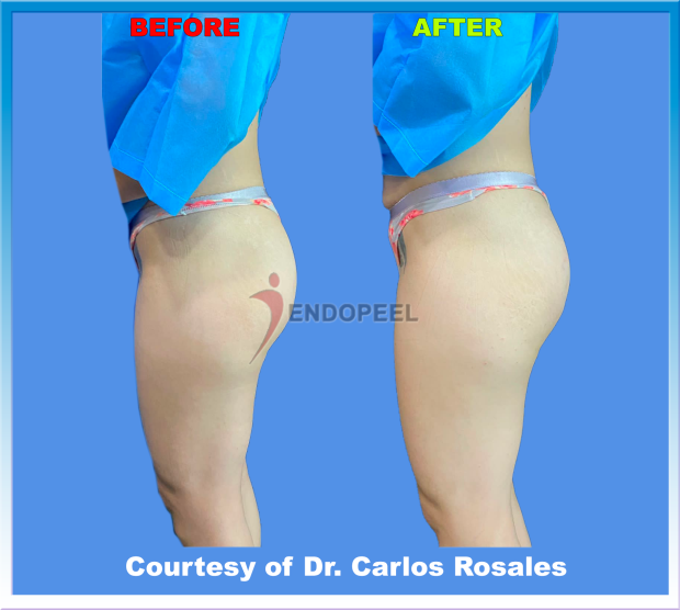 economic-female-gluteoplasty-L-profile