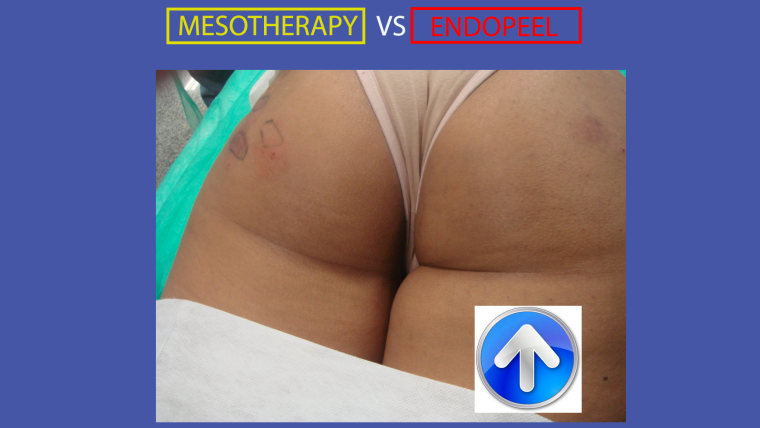 mesotherpay vs endopeel