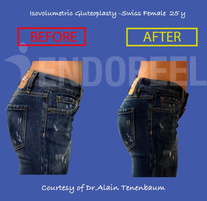 Projection on Swiss Young Female- Back View