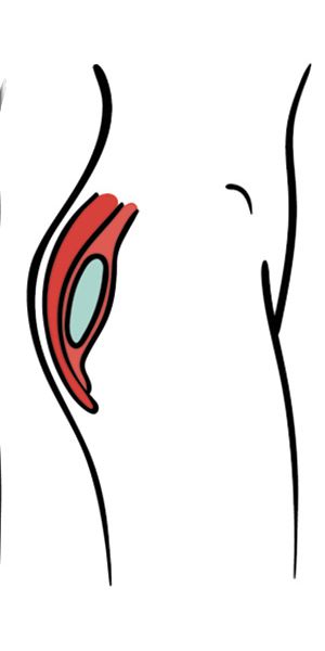 intermuscular-gluteal-implant