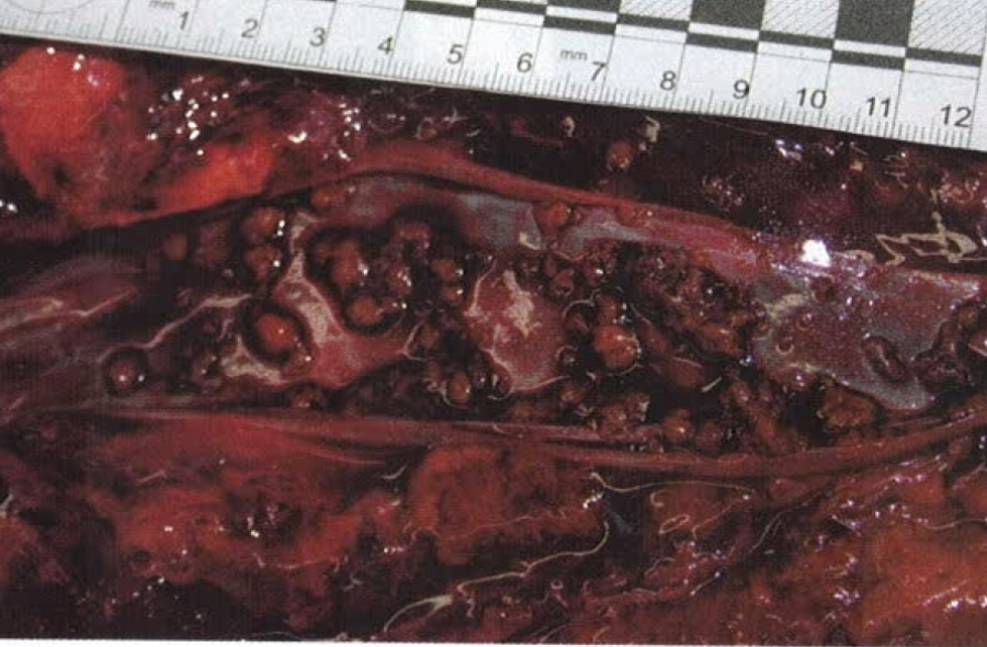fat embolism post gluteal lipoinjection