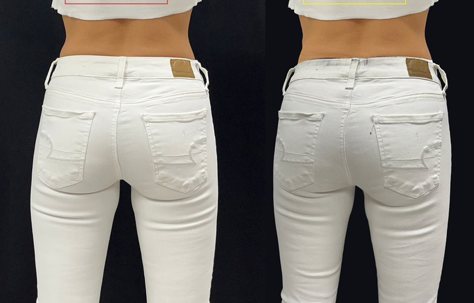 zoom on mexican female endopeel gluteoplasty