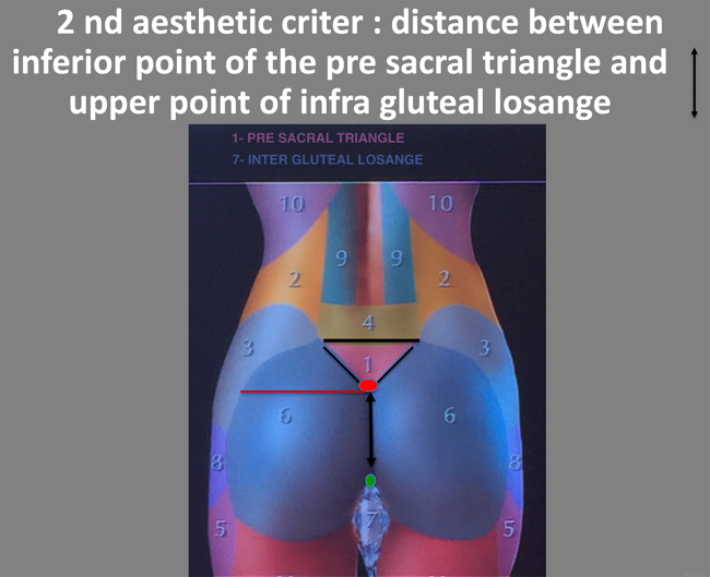 vertical distance presacral-infragluteal