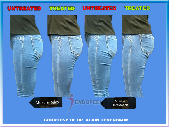 female gluteal projection