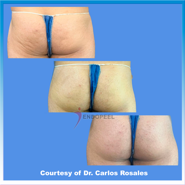 mature-male-cellulitis-gluteoplasty-evolution